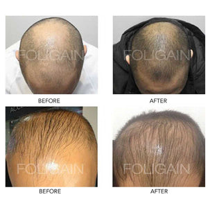 MINOXIDIL BEFORE AND AFTER 