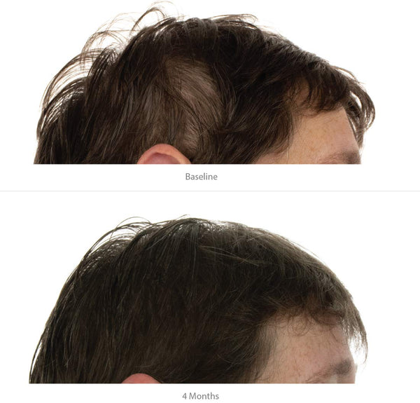 FOLIGAIN Advanced Hair Regrowth Hair Shampoo Minoxidil 2% - FOLIGAIN EUROPE